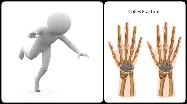 Physical Therapy for a Colles' Fracture